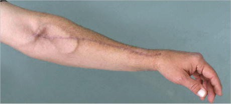 Arteriovenous (AV) Fistula Creation & Vascular Access Care