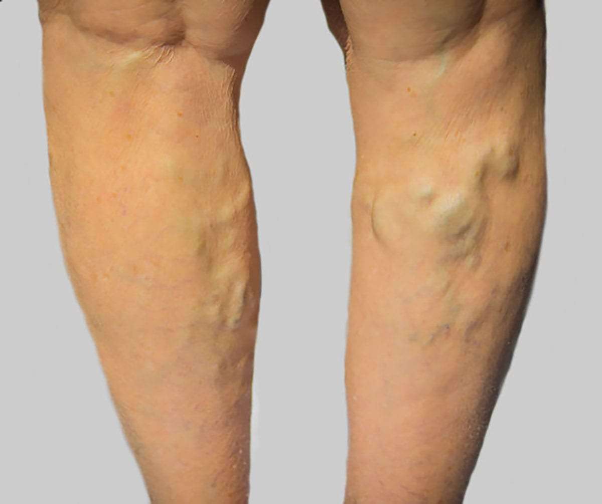 Comprehensive Varicose Vein Treatment & Venous Disease Management